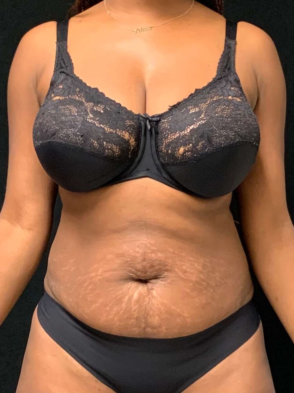 Abdominoplasty / Tummy Tuck Before