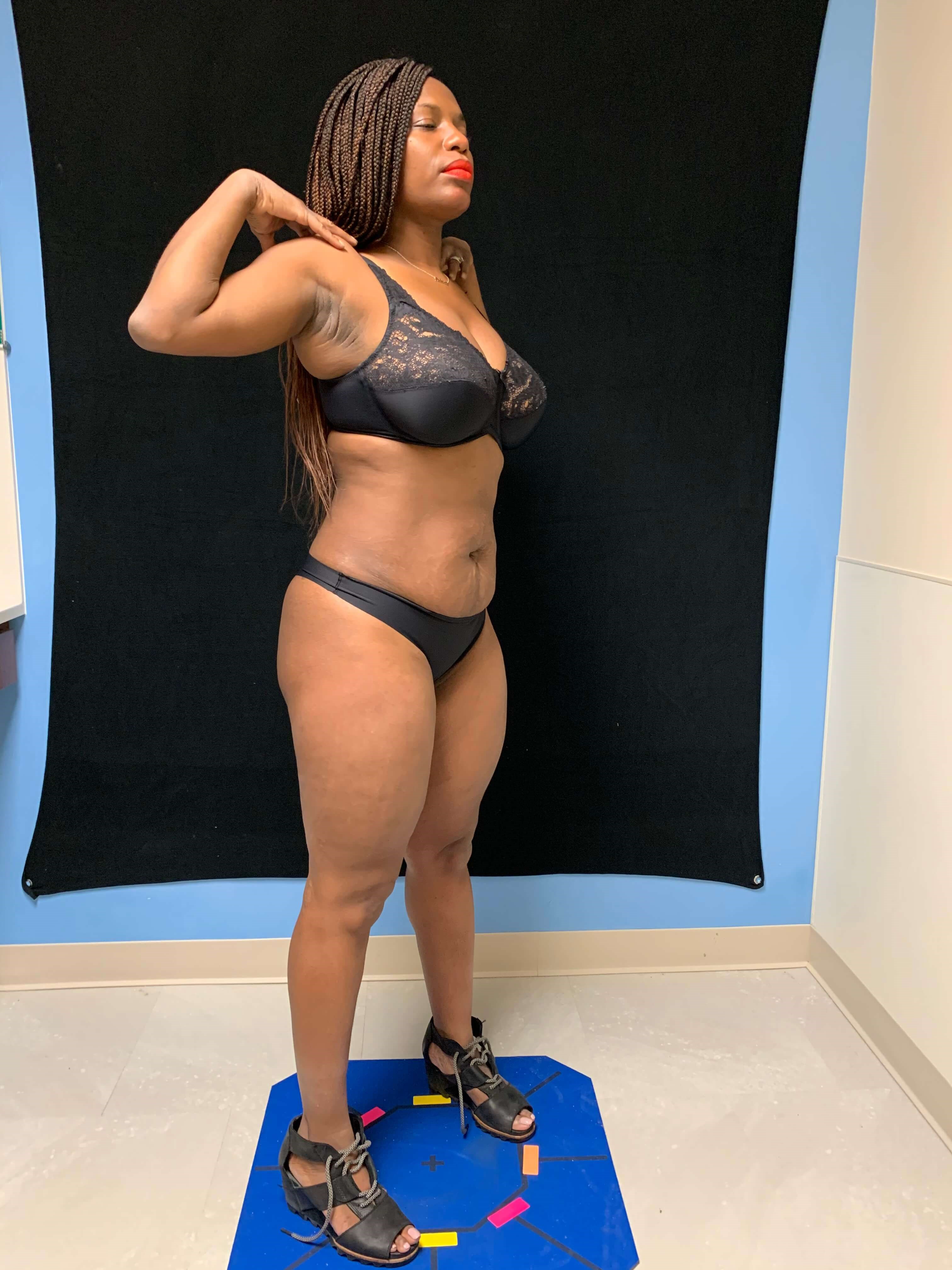 Liposuction / Liposculpture Before