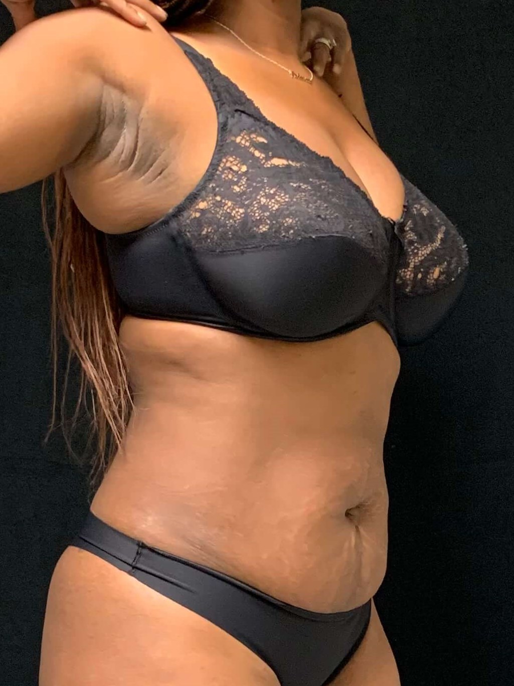 Liposuction / Liposculpture Before