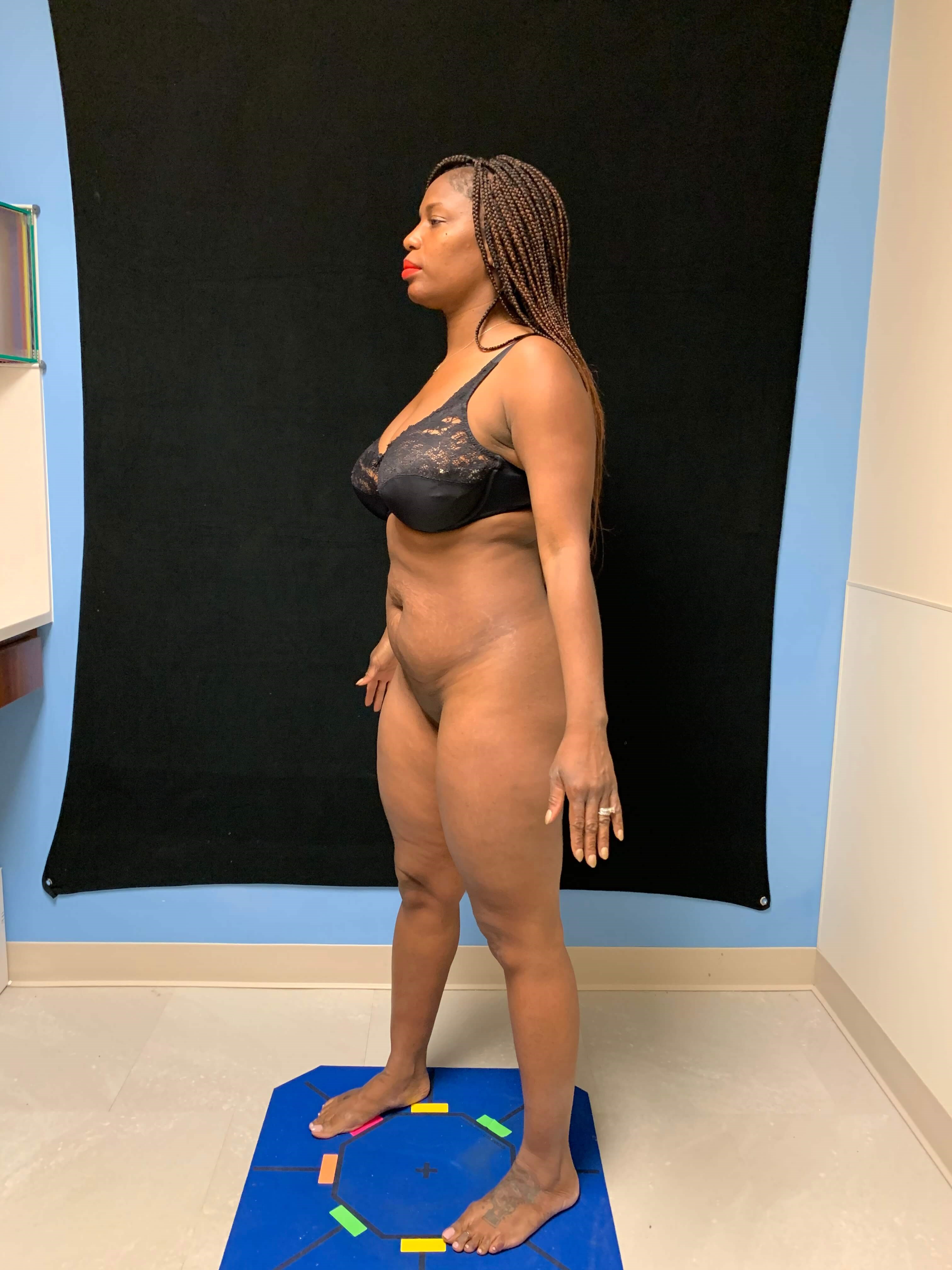 Abdominoplasty / Liposuction Before