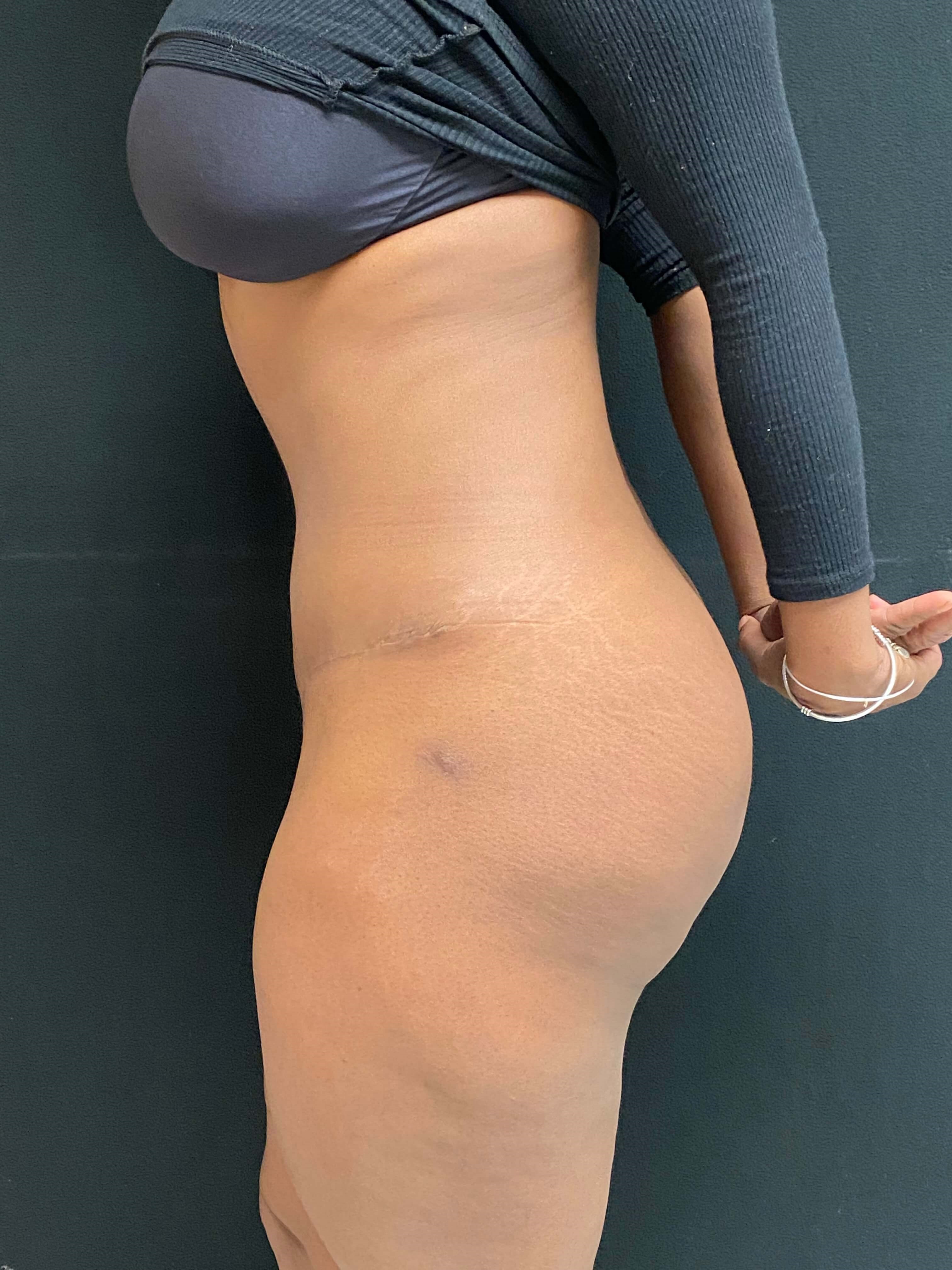 Abdominoplasty / Tummy Tuck After