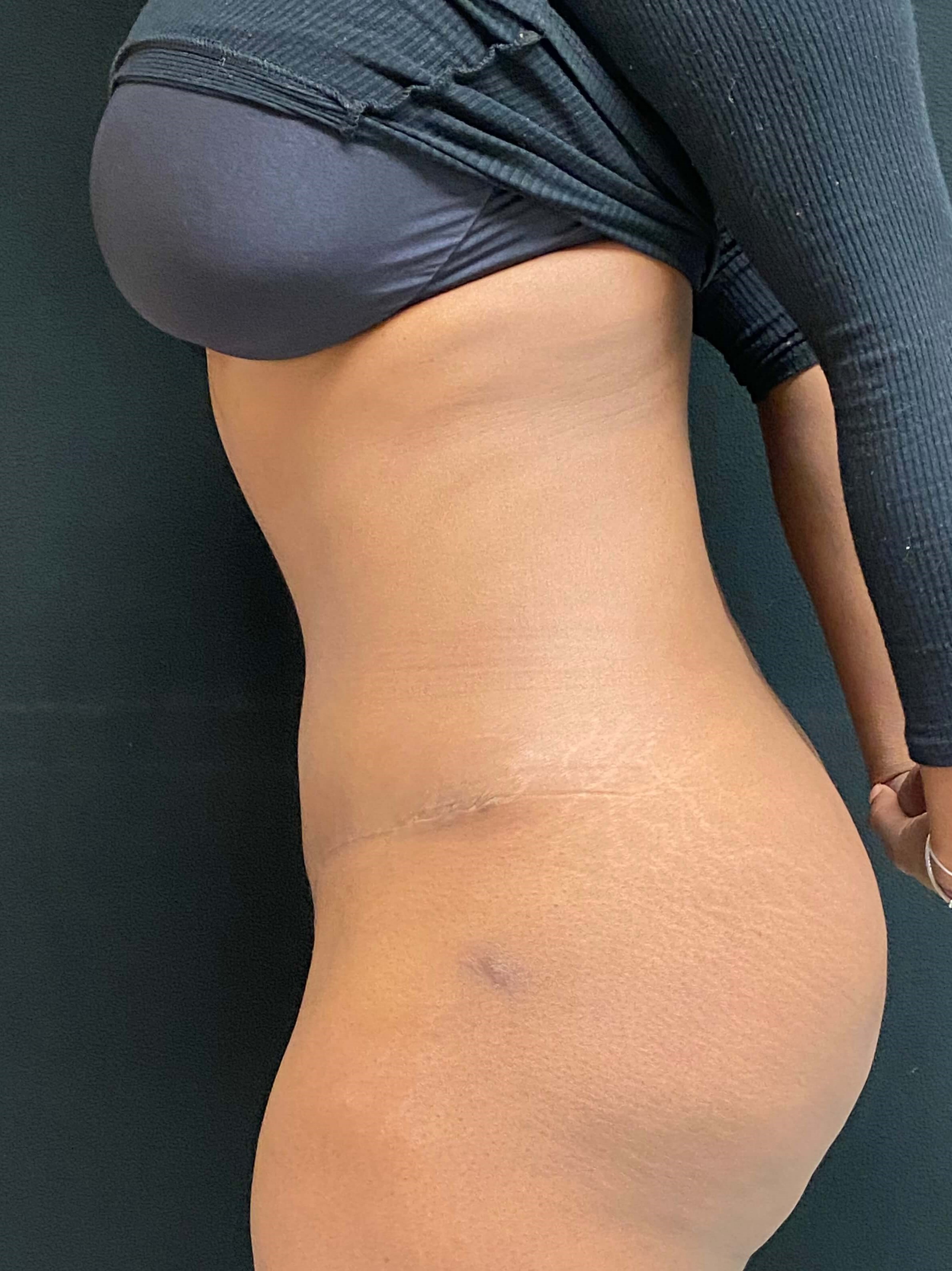 Abdominoplasty / Tummy Tuck After