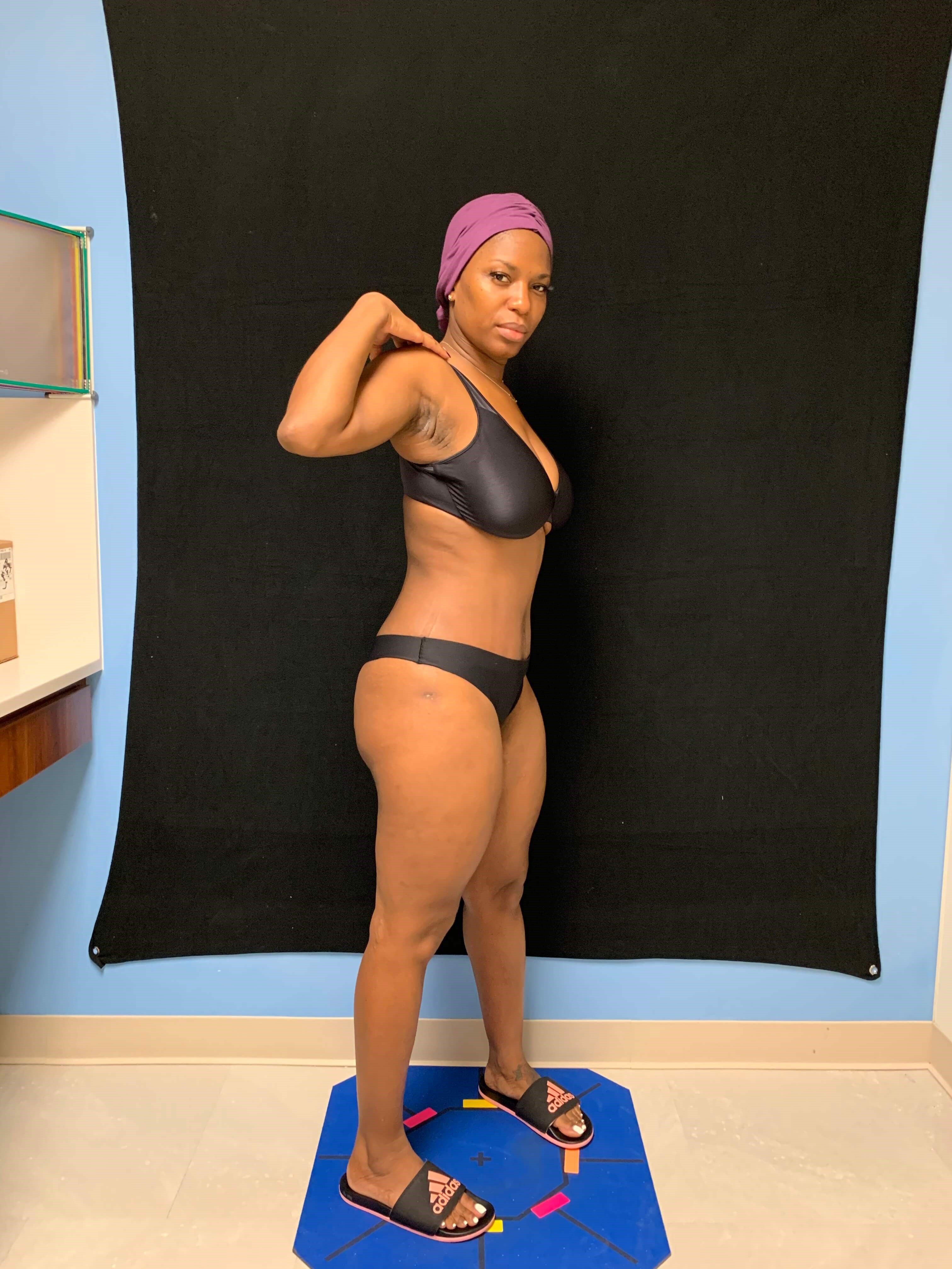 Liposuction / Liposculpture After