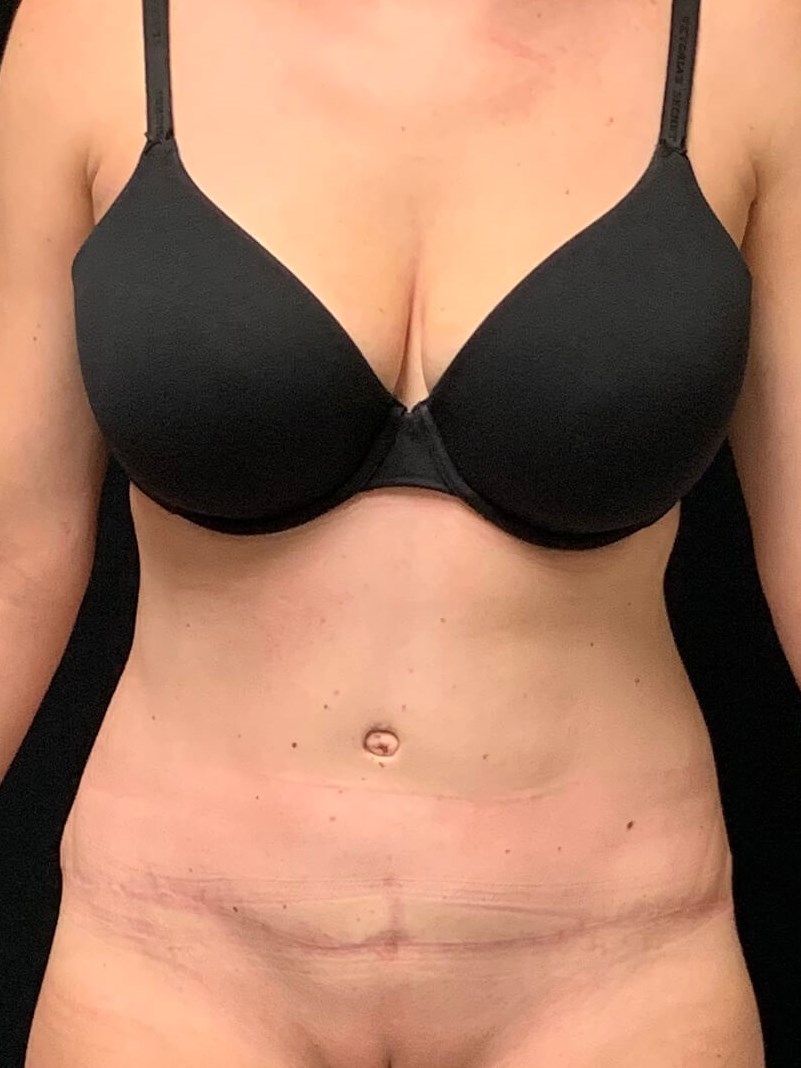 Tummy Tuck / Abdominoplasty After