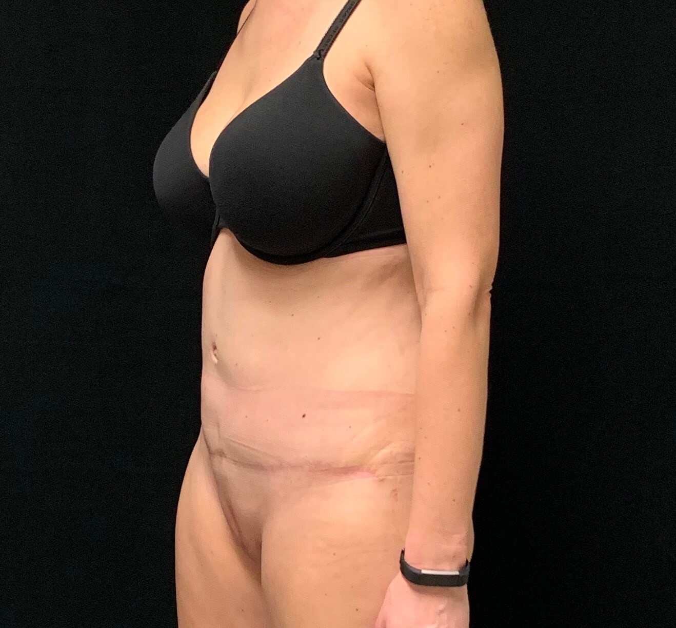 Abdominoplasty / Tummy Tuck After