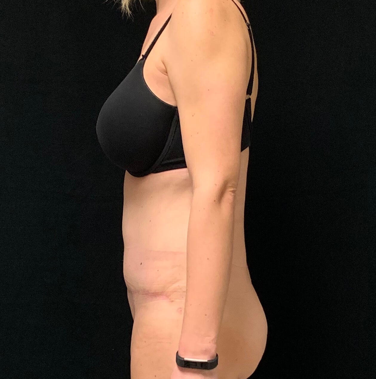 Abdominoplasty / Tummy Tuck After