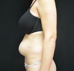 Abdominoplasty / Tummy Tuck Before