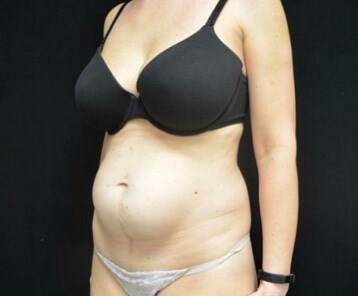 Abdominoplasty / Tummy Tuck Before