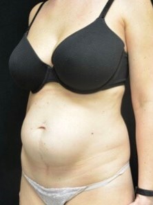 Abdominoplasty / Tummy Tuck Before