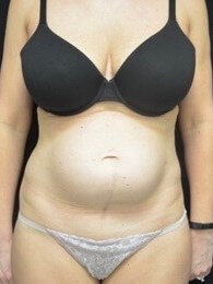 Tummy Tuck / Abdominoplasty Before