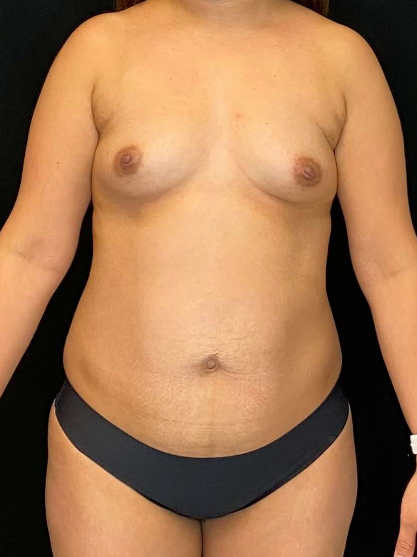 Mommy Makeover Before