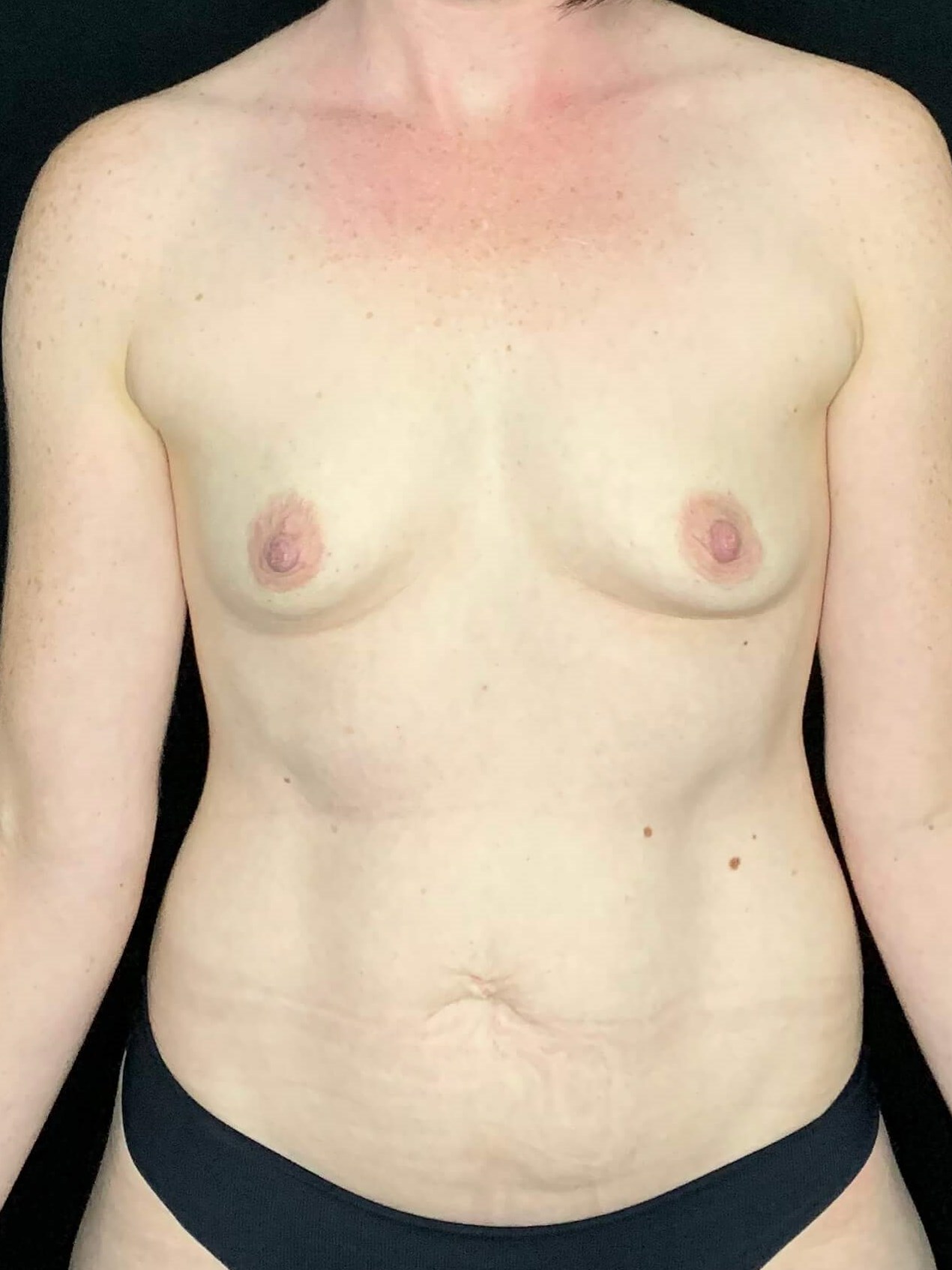 Breast Augmentation Before
