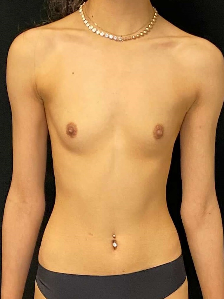 Breast Augmentation Before