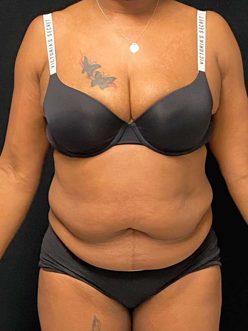 Before and After Tummy Tuck Before