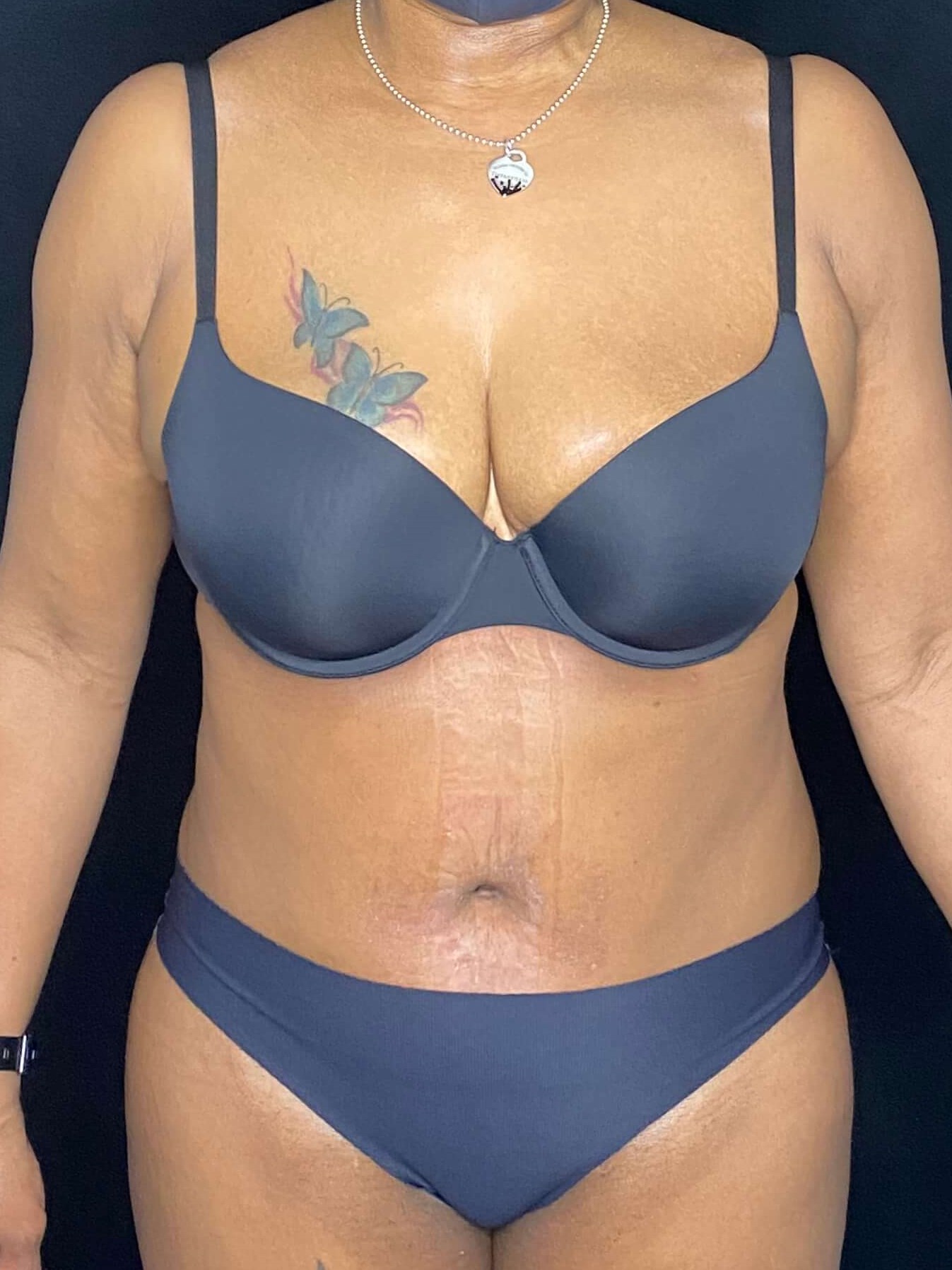 Before and After Tummy Tuck After