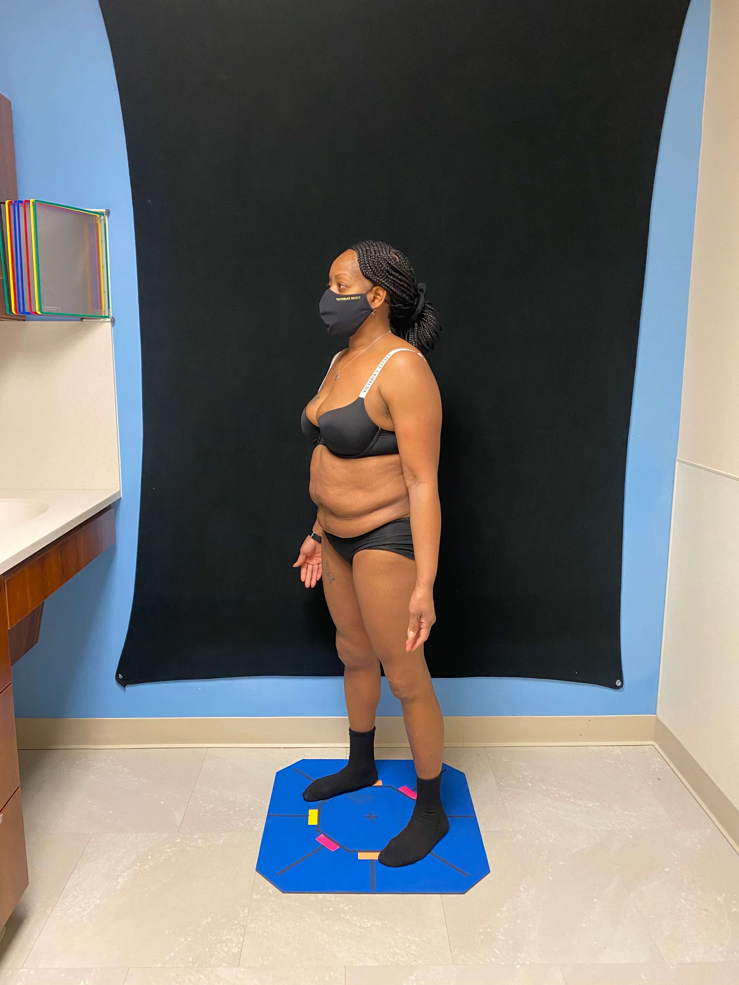 Abdominoplasty Liposuction Before