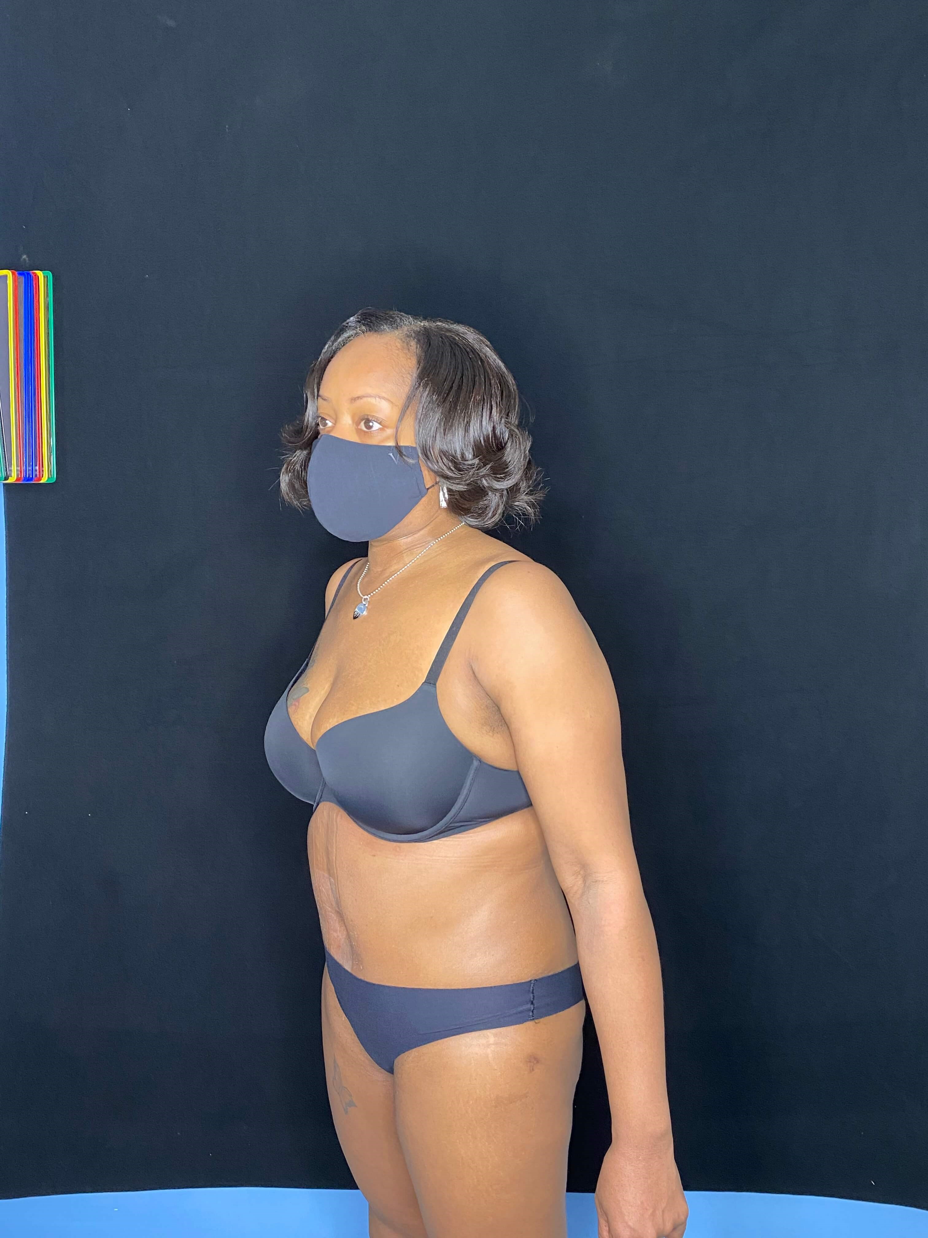 Abdominoplasty Liposuction After