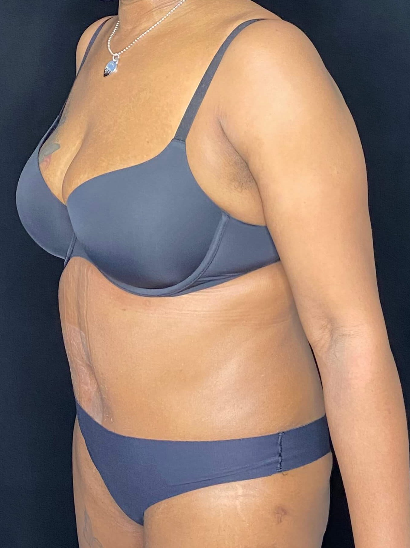 Abdominoplasty Liposuction After