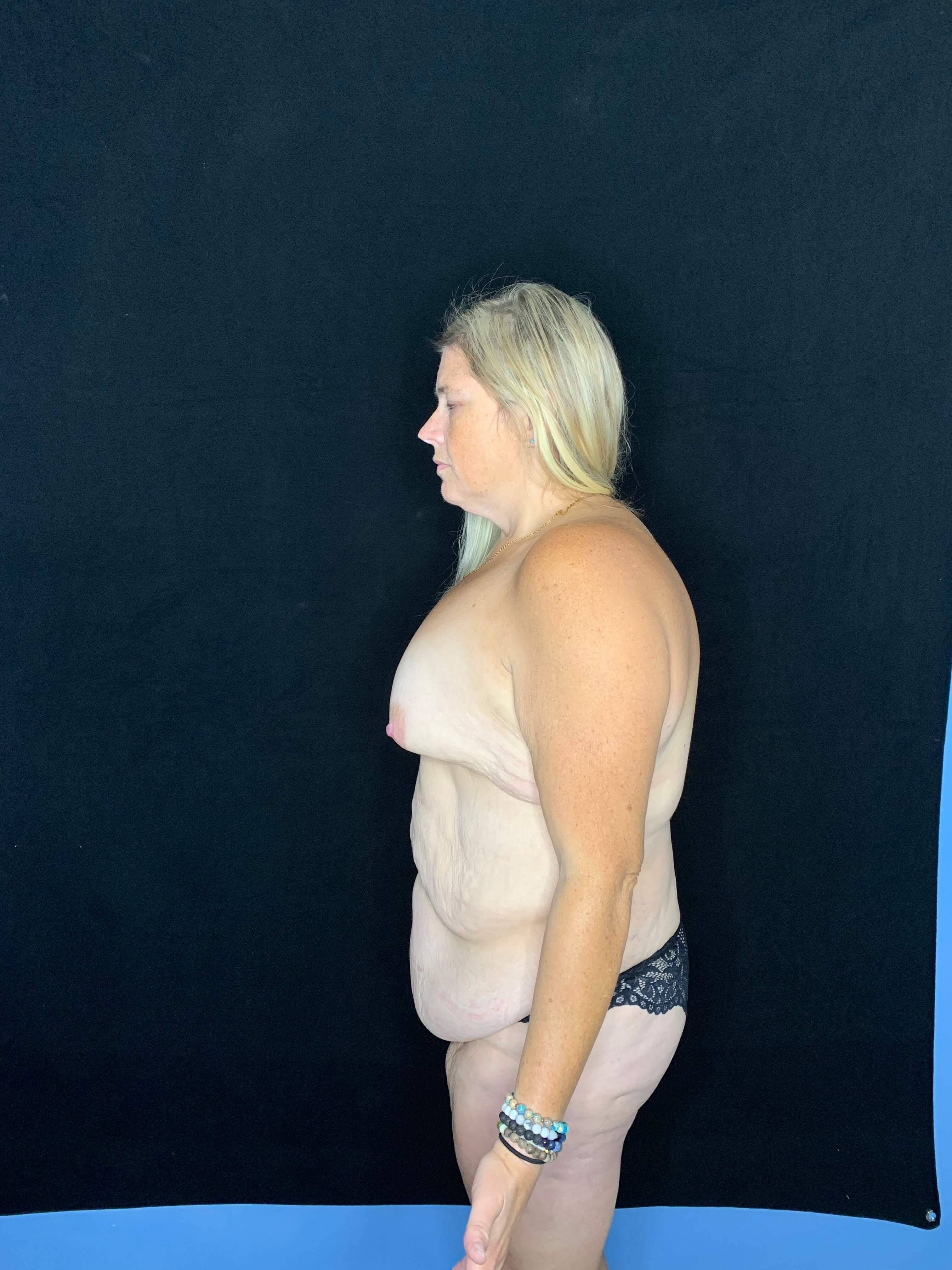Belt Lipectomy Body Contouring Before