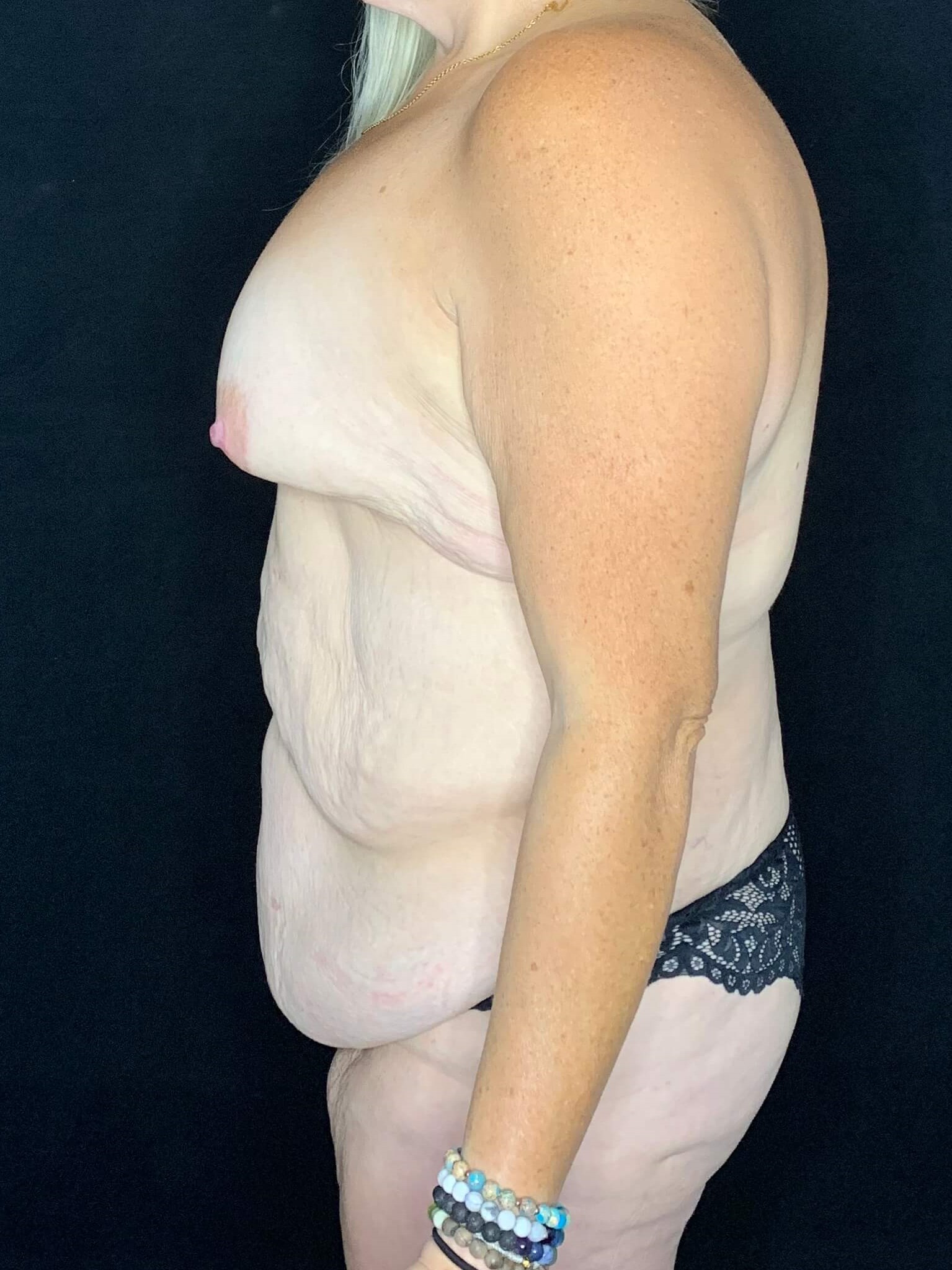 Belt Lipectomy Body Contouring Before