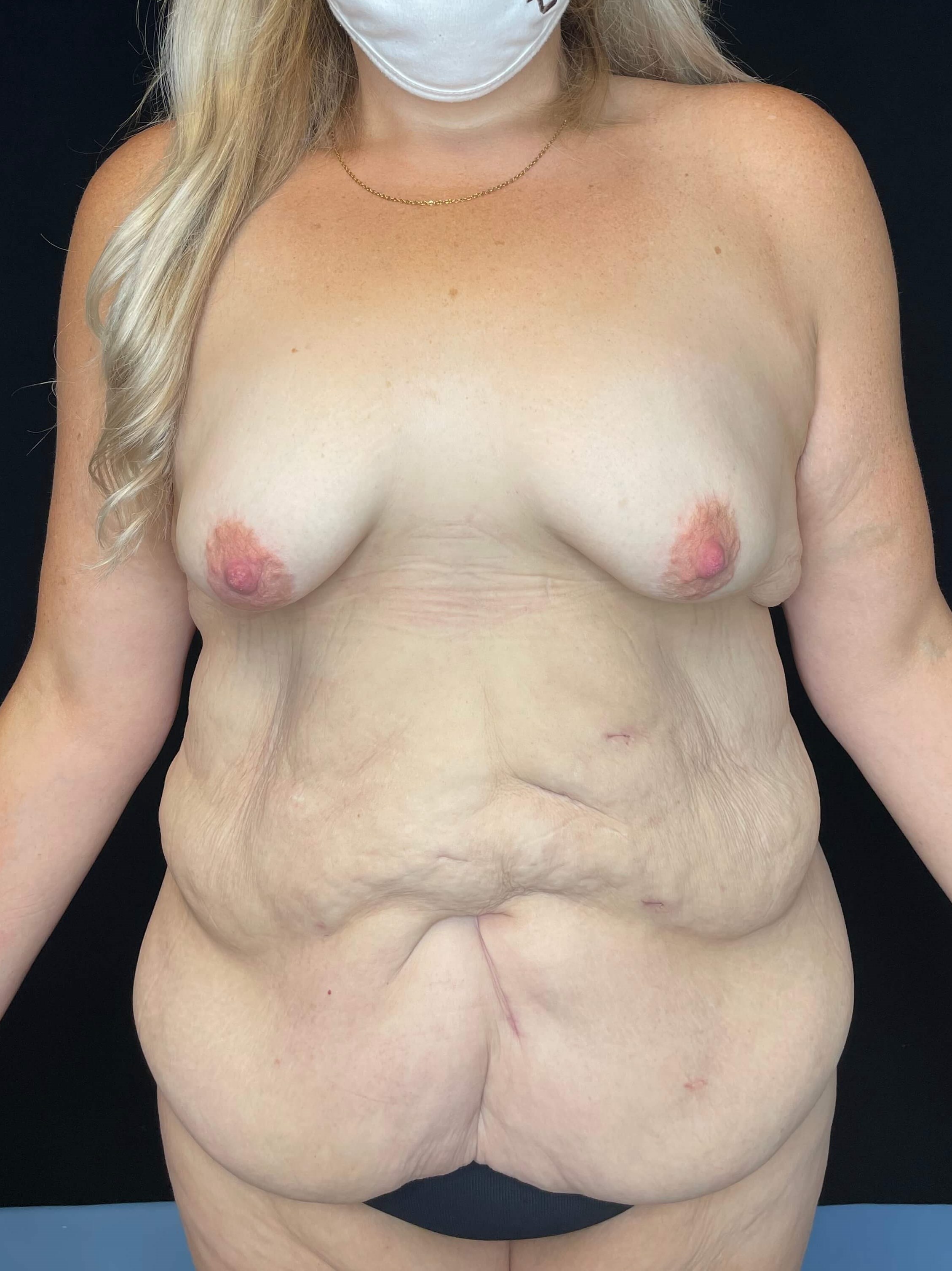 Abdominoplasty Belt Lipectomy Before