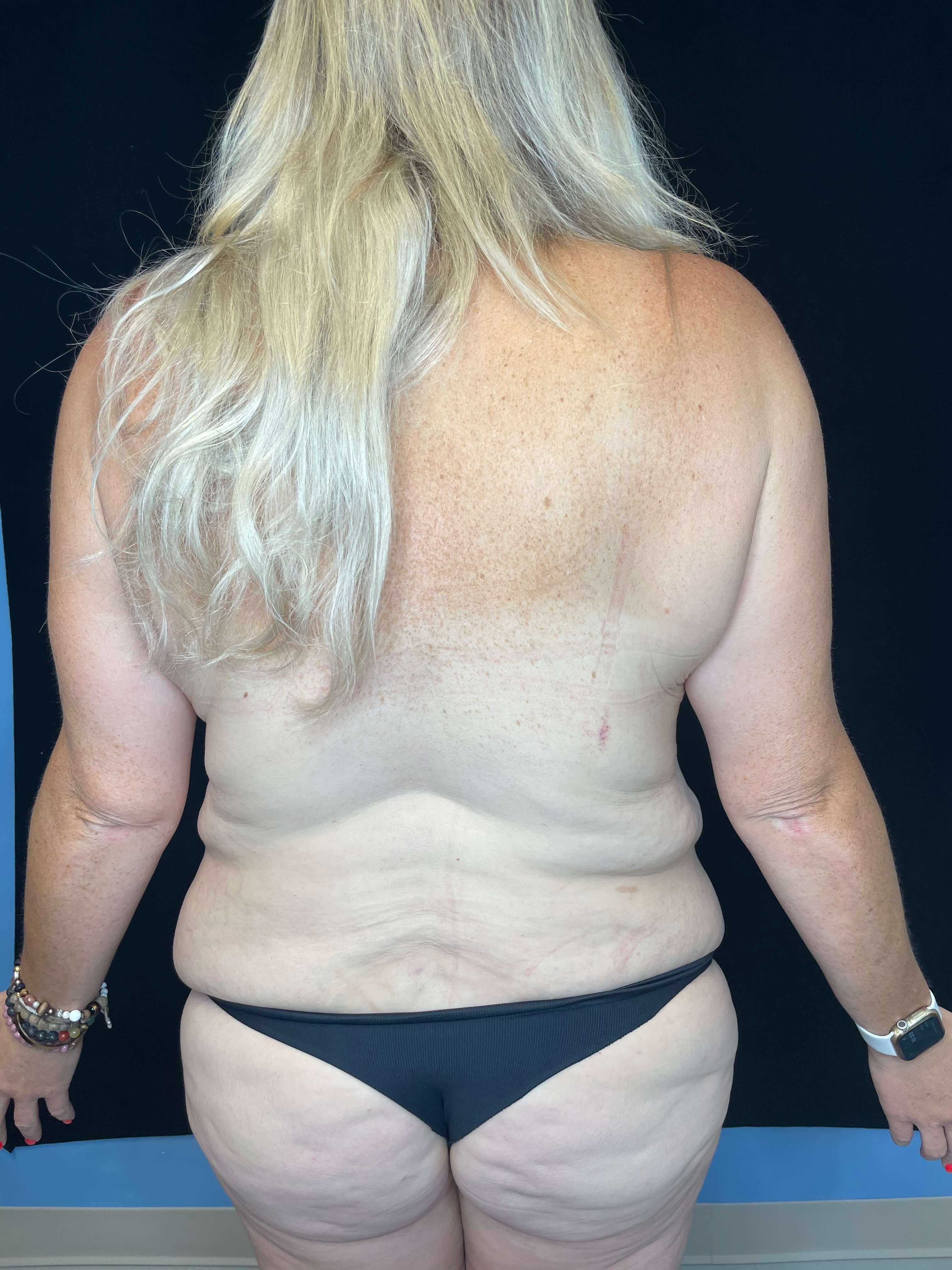 Tummy Tuck Abdominoplasty Before