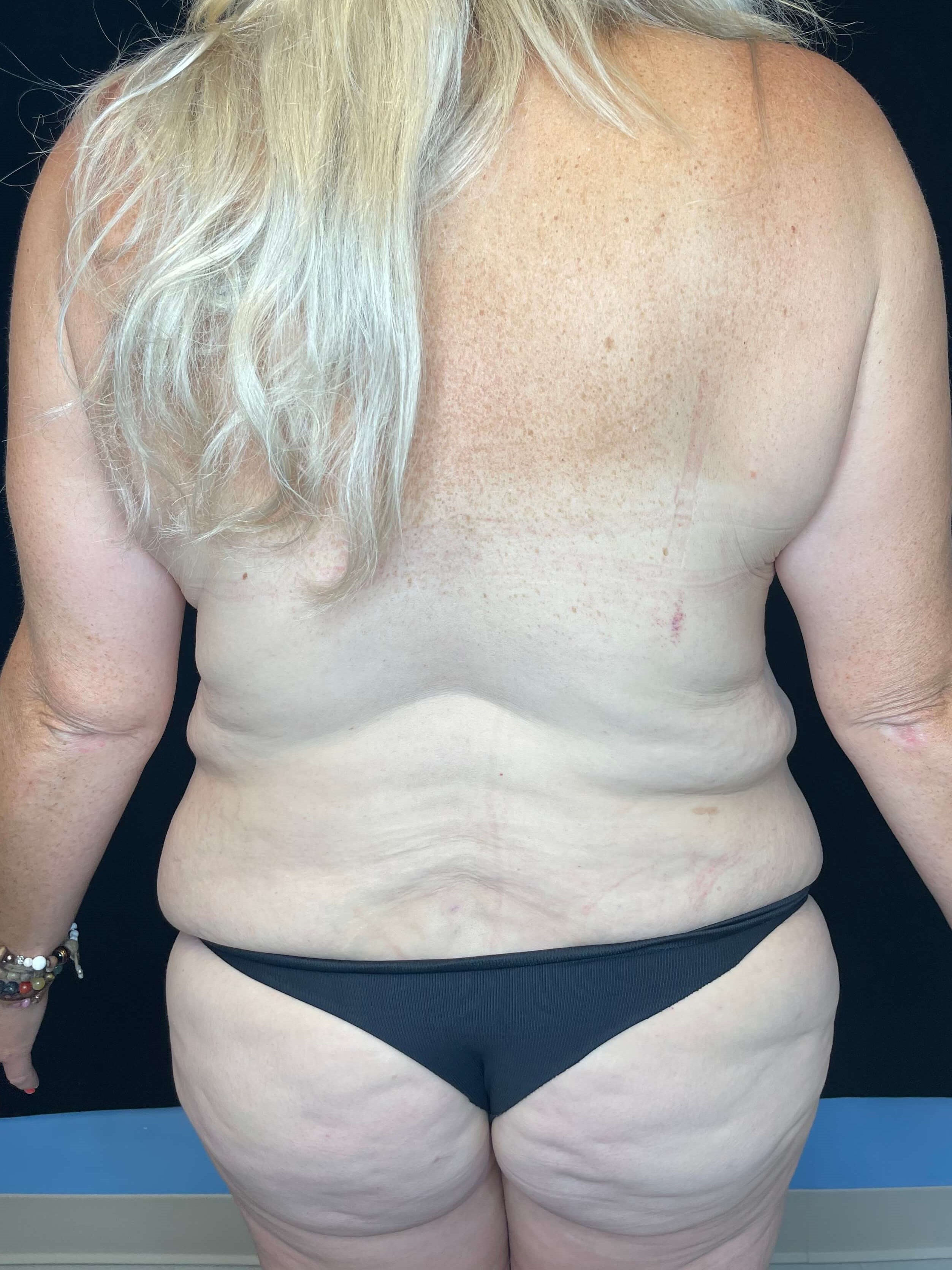 Tummy Tuck Abdominoplasty Before