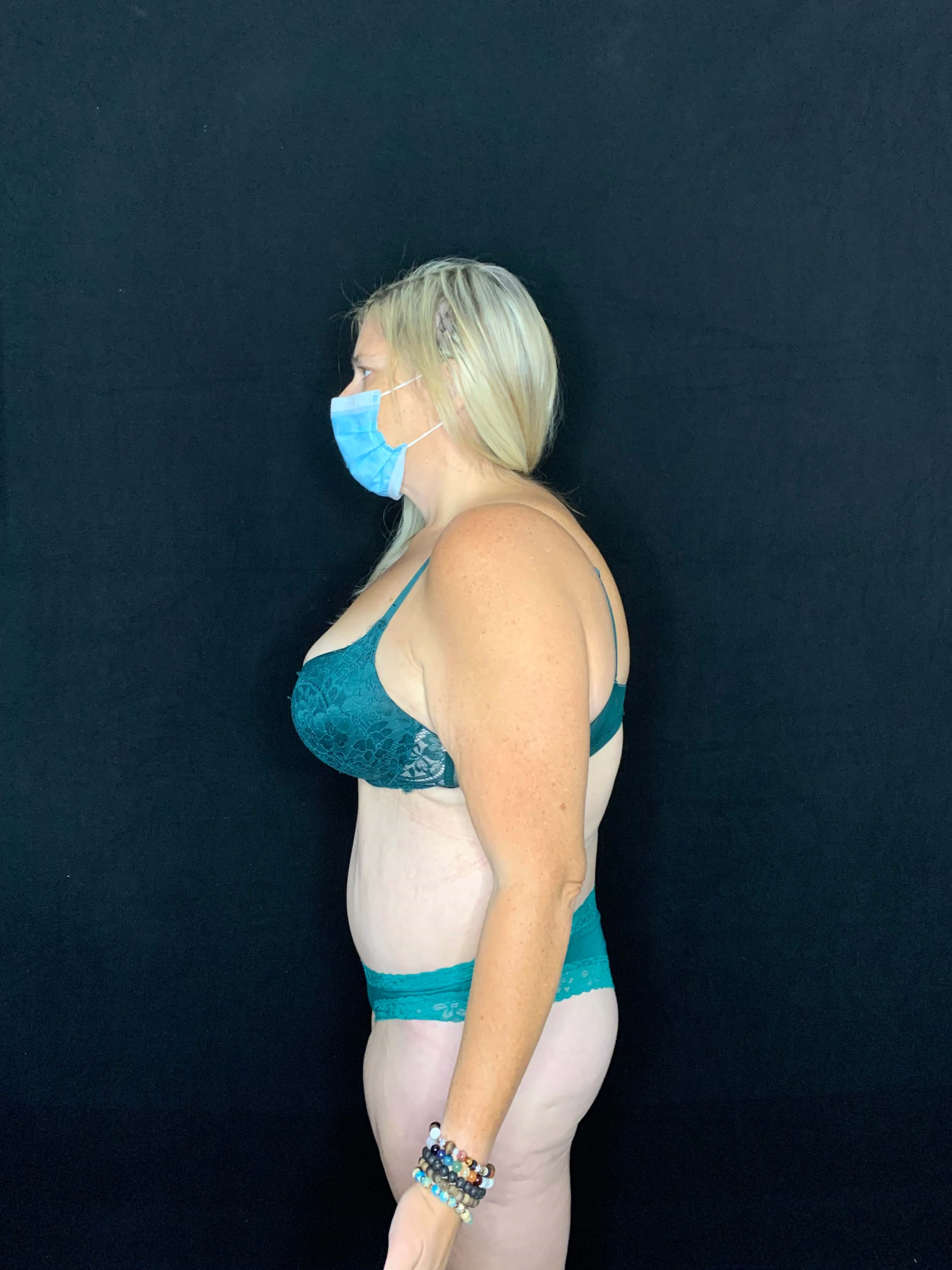 Belt Lipectomy Body Contouring After