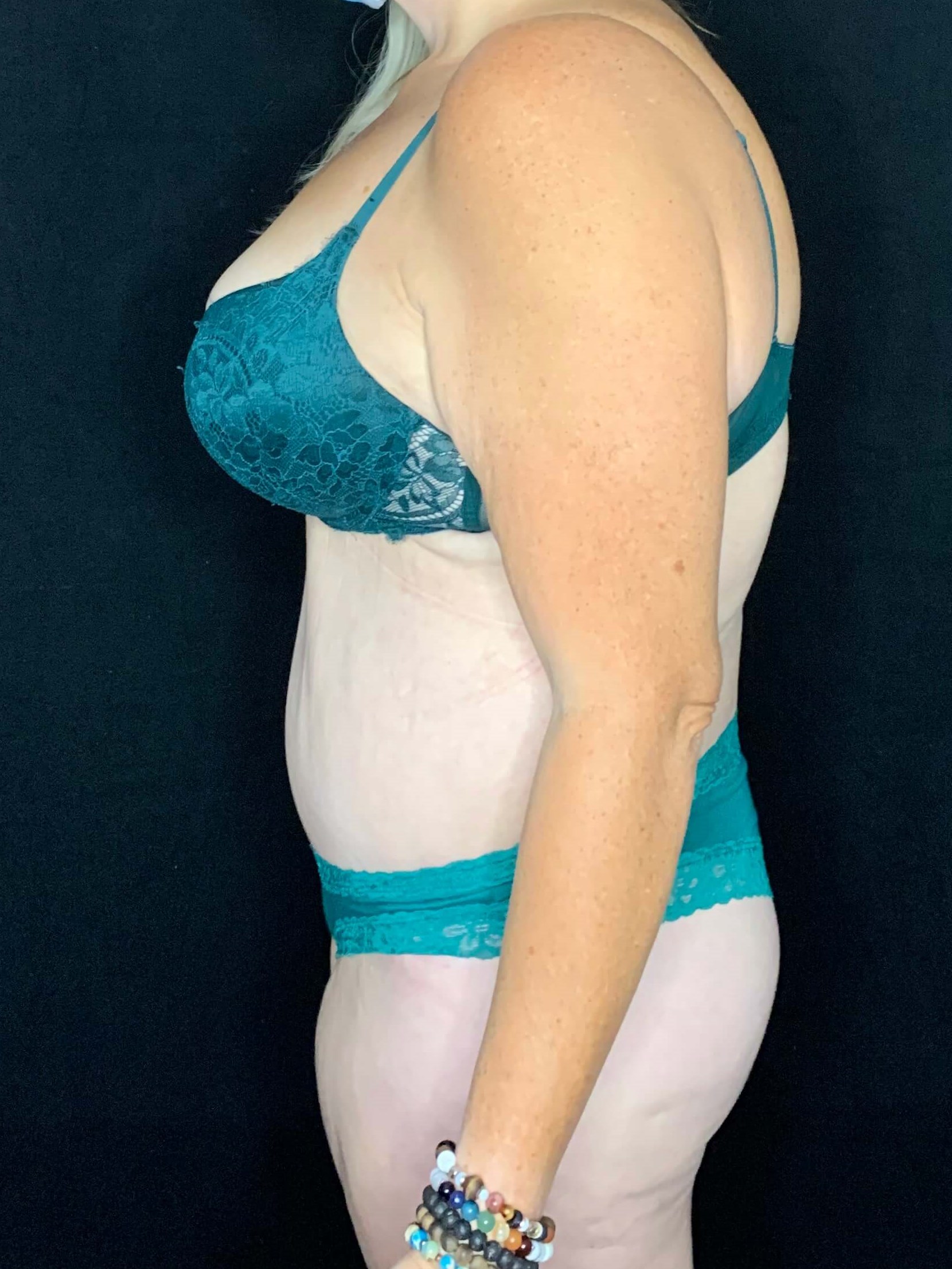 Belt Lipectomy Body Contouring After