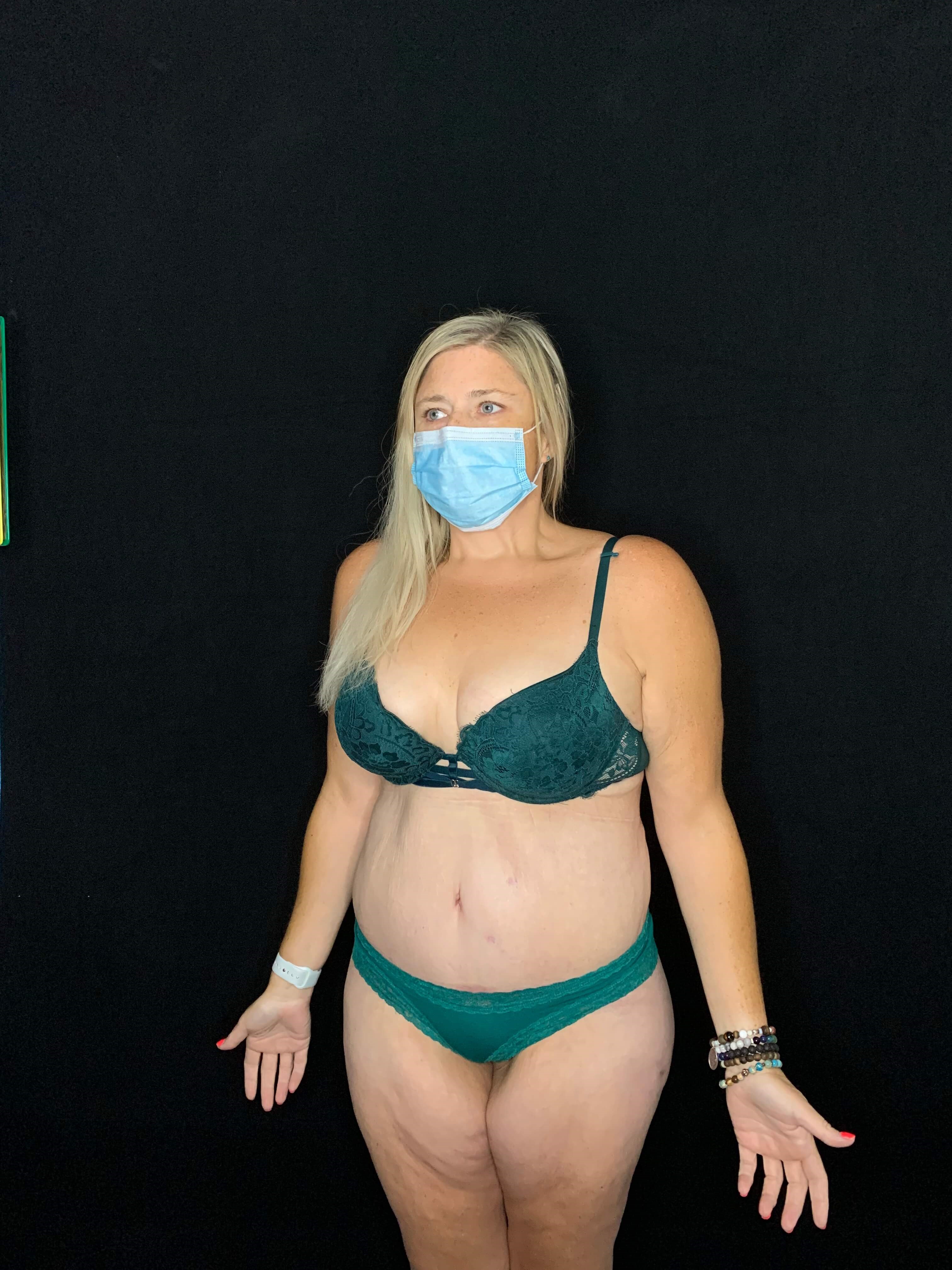 Lower Body Lift Tummy Tuck After