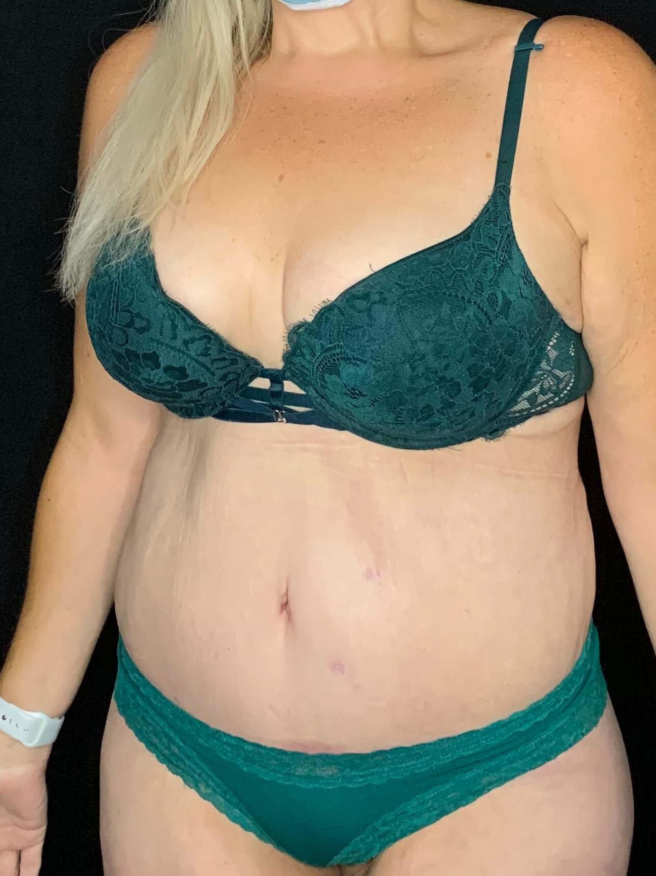 Lower Body Lift Tummy Tuck After