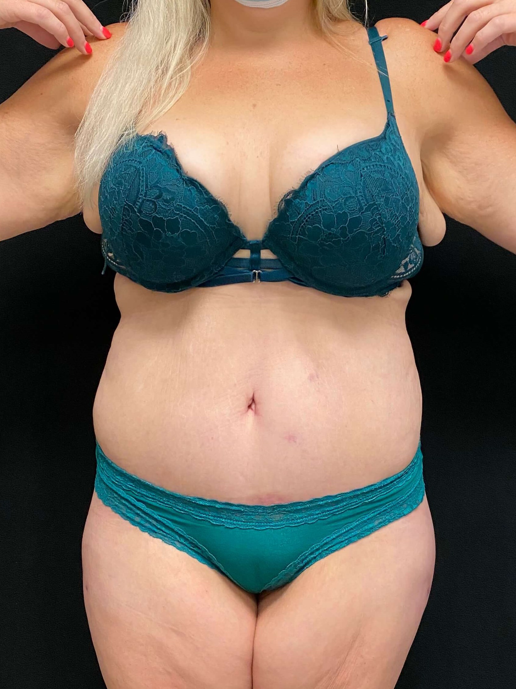 Abdominoplasty Belt Lipectomy After