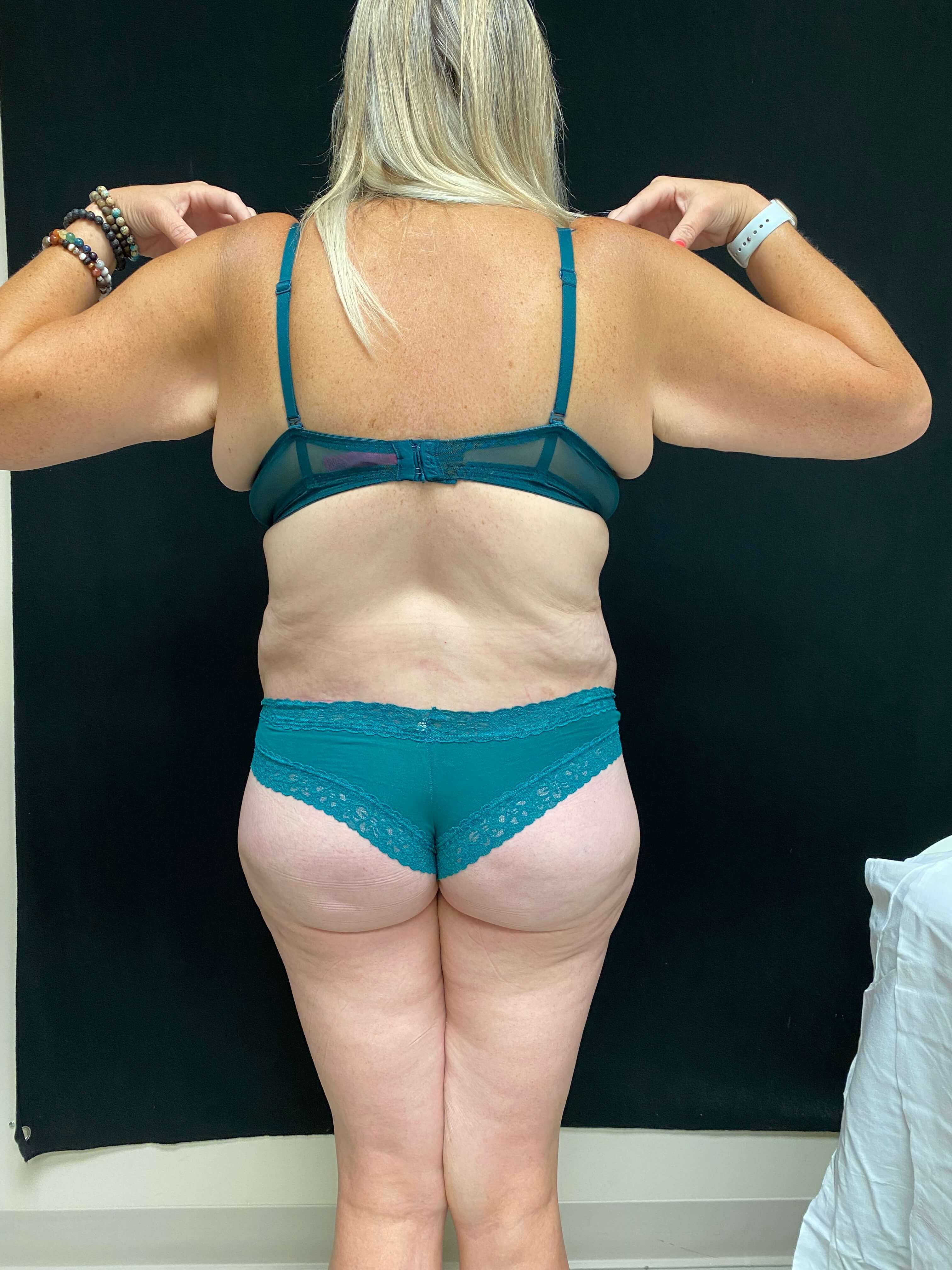 Tummy Tuck Abdominoplasty After