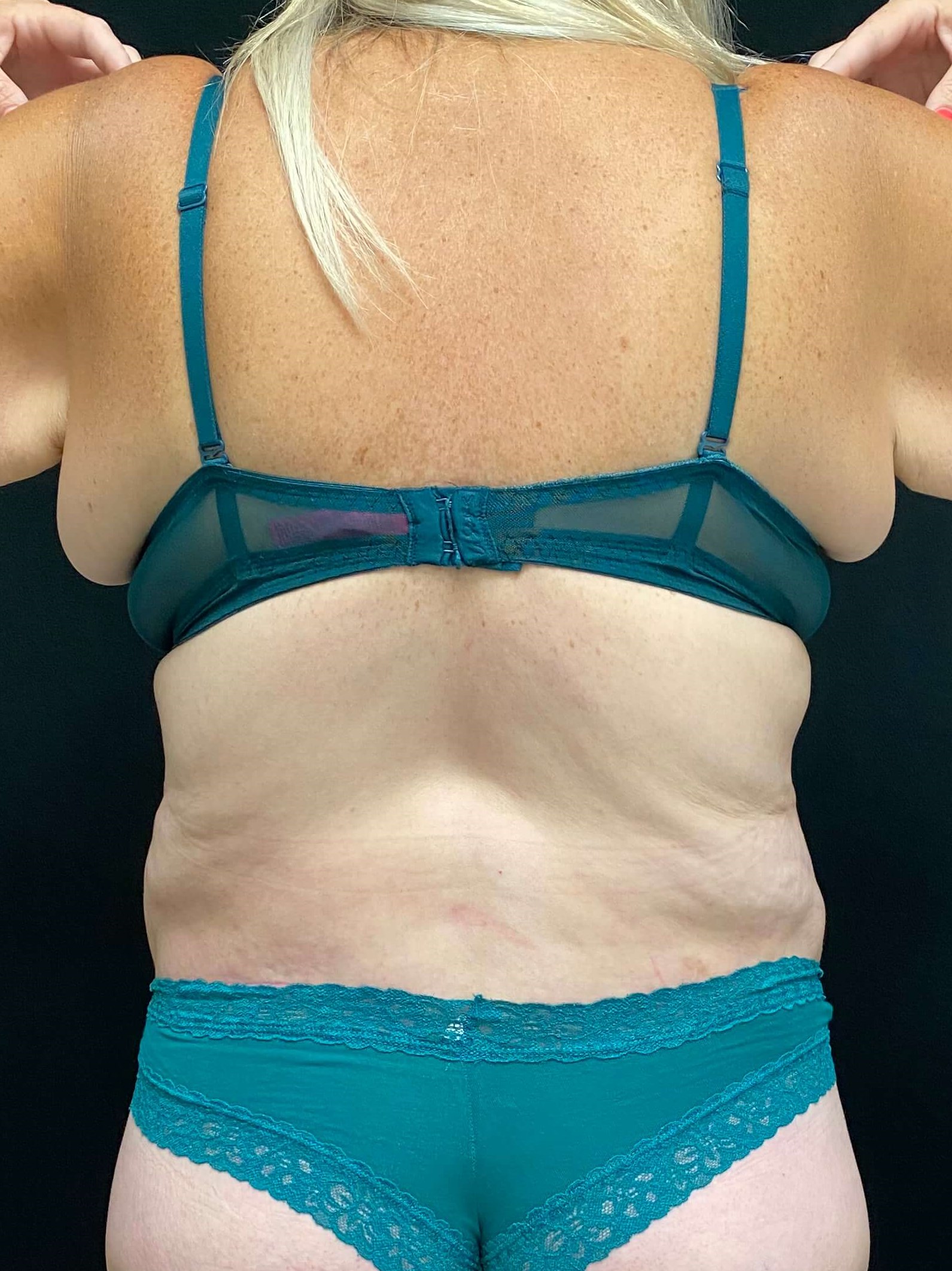 Tummy Tuck Abdominoplasty After