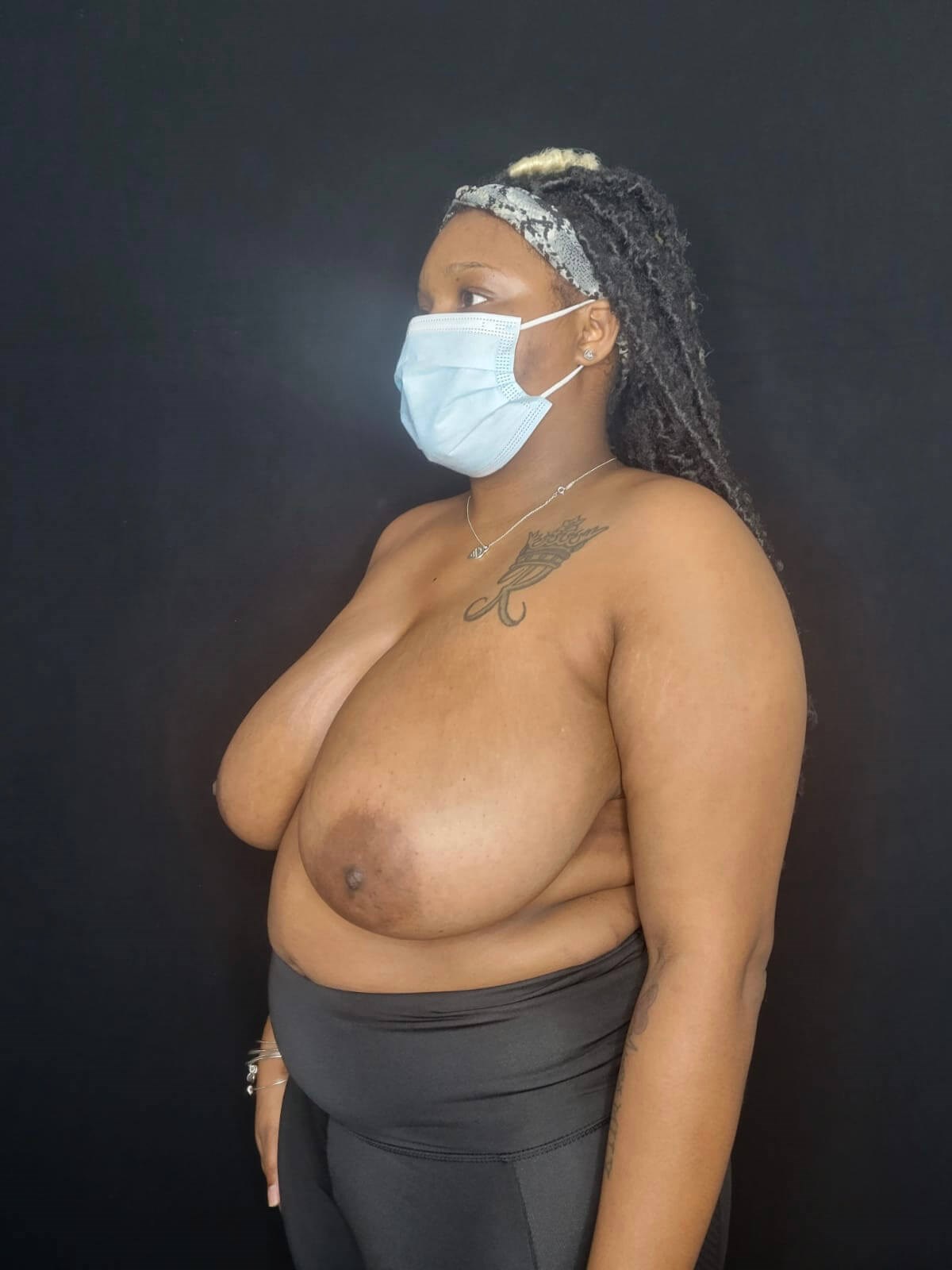 Breast Reduction Lift Before