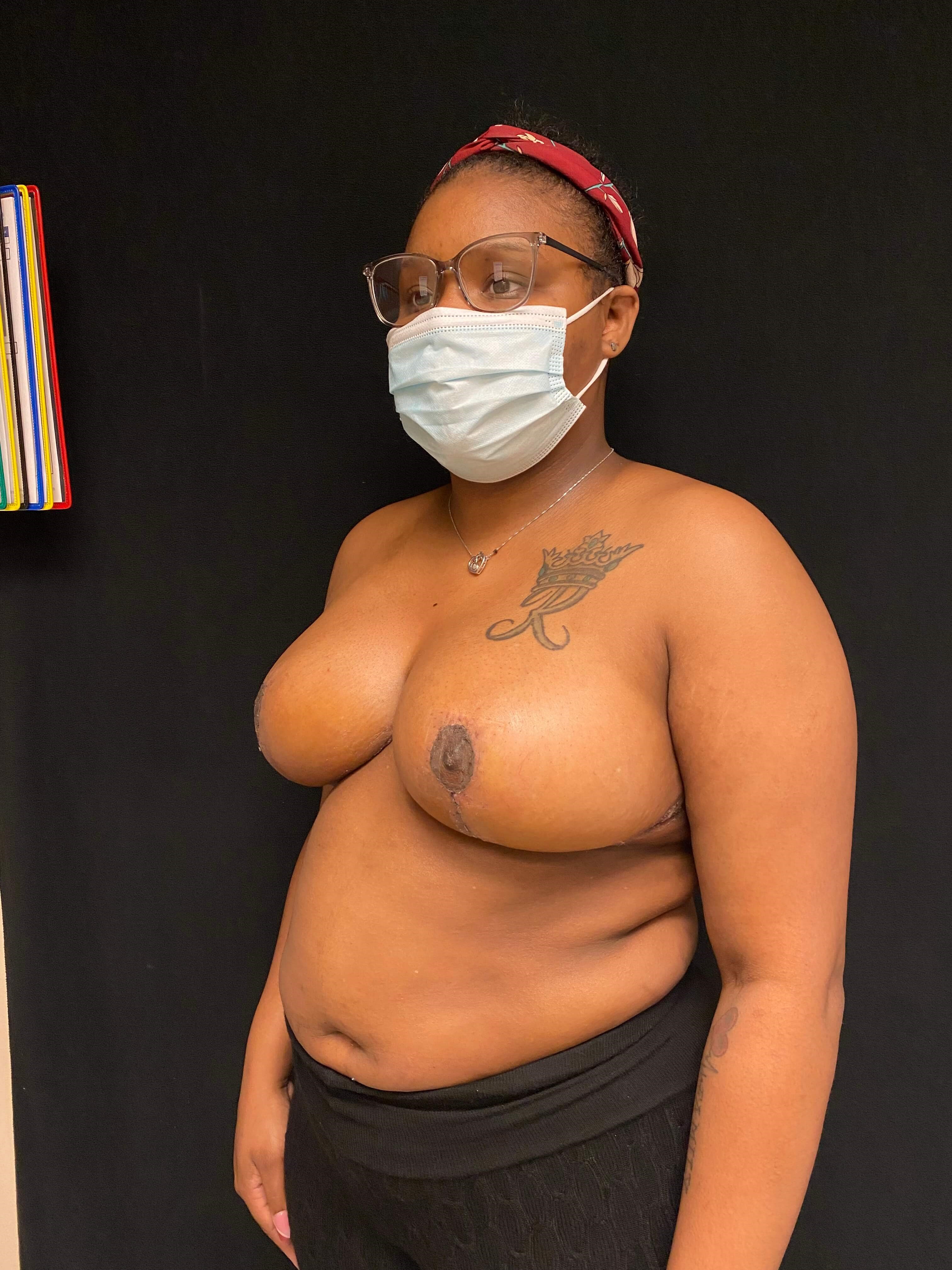 Breast Reduction Lift After