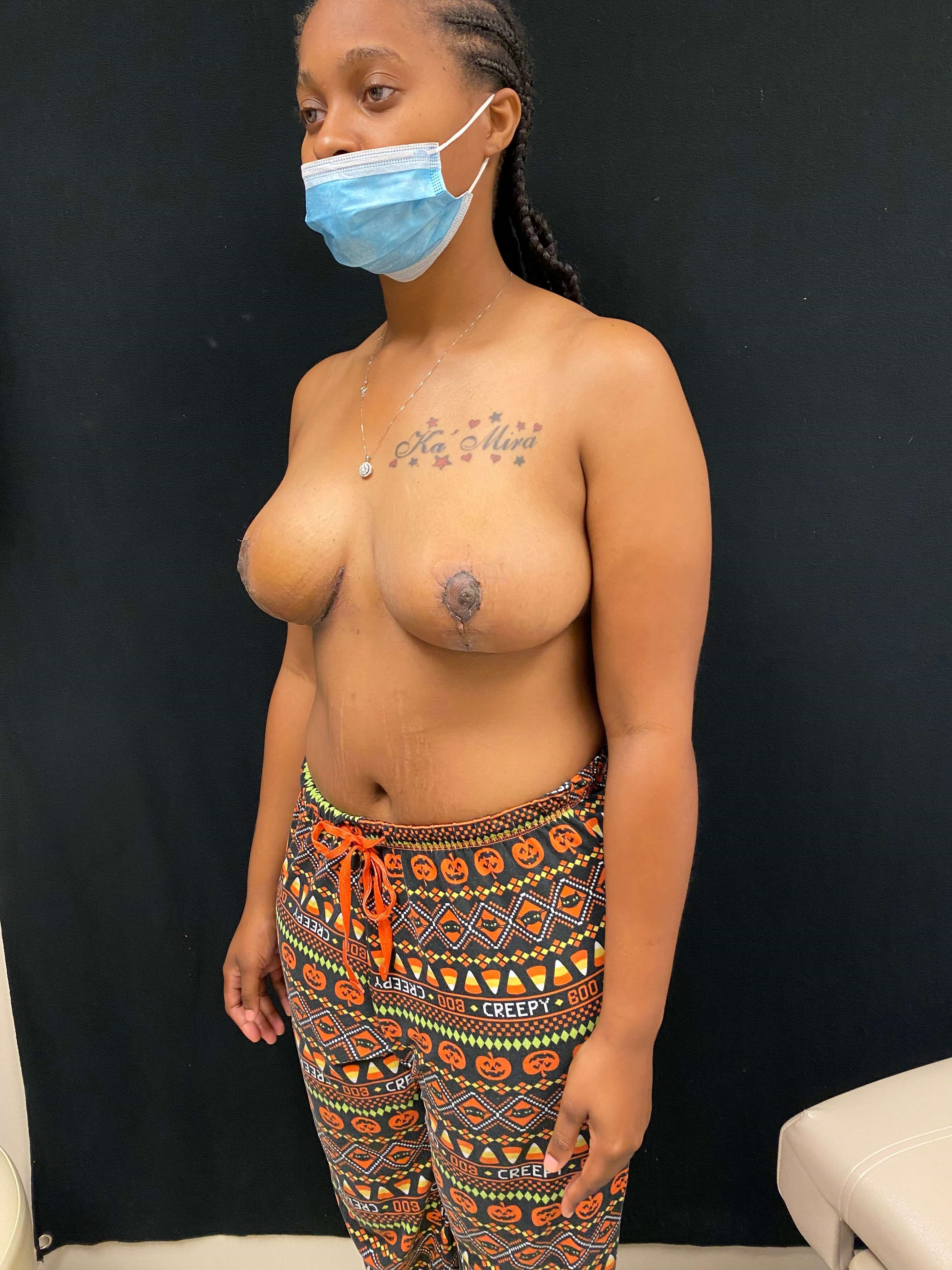 Breast Reduction Lift After