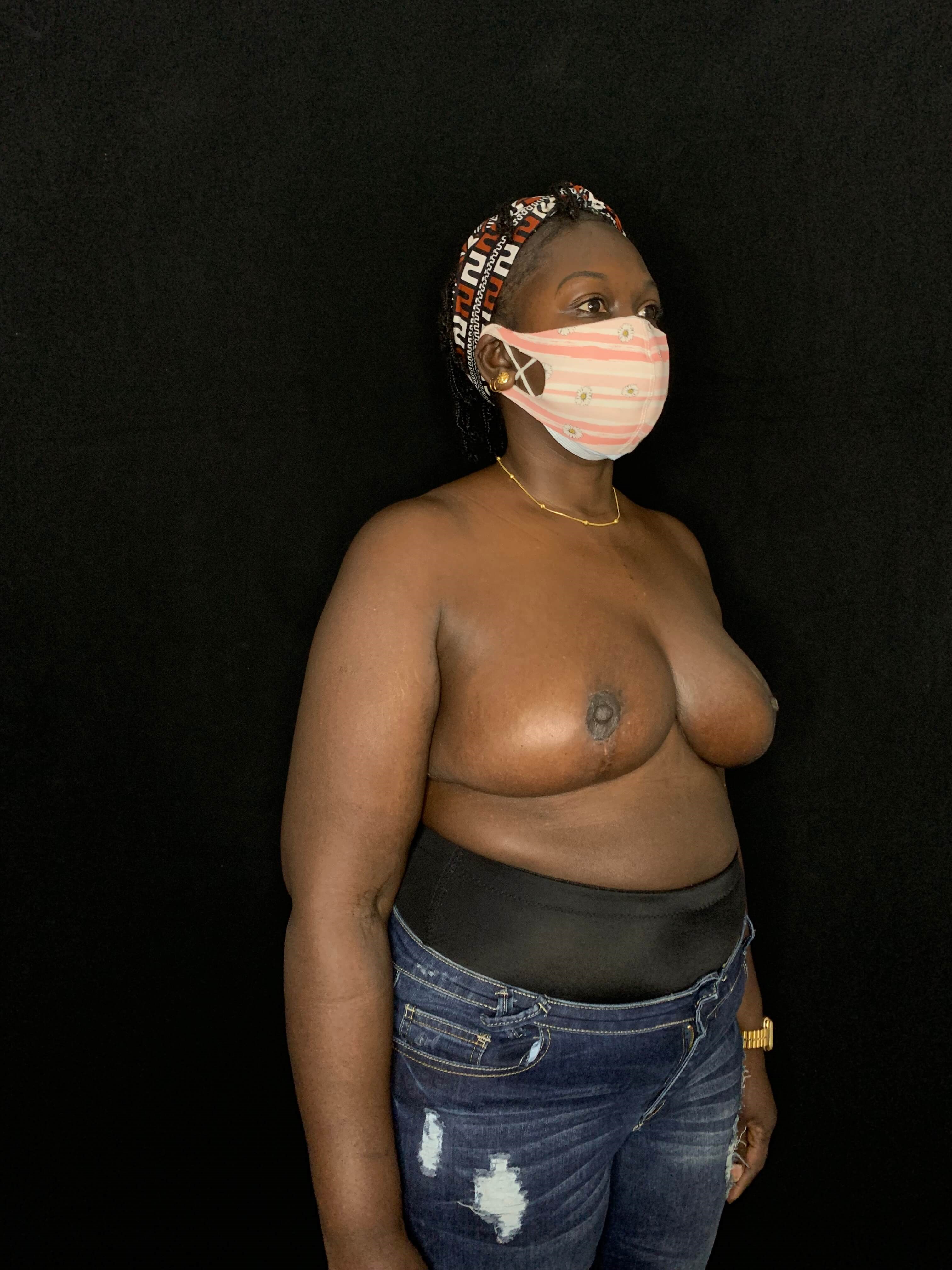 Mastopexy Breast Reduction After