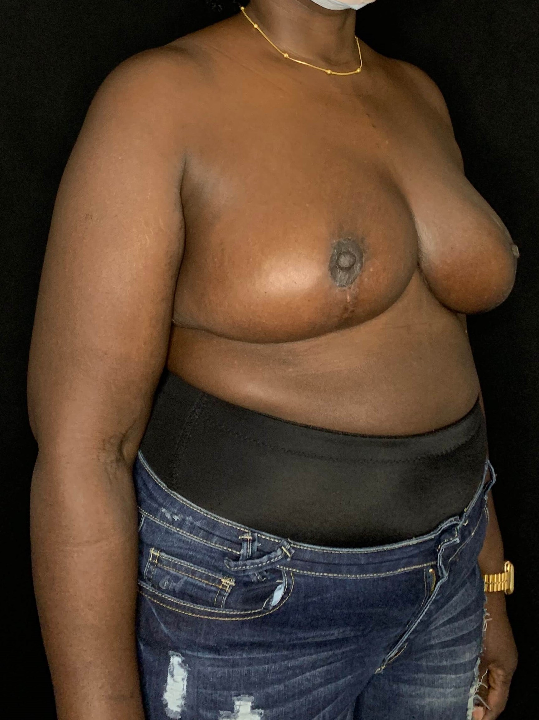 Mastopexy Breast Reduction After