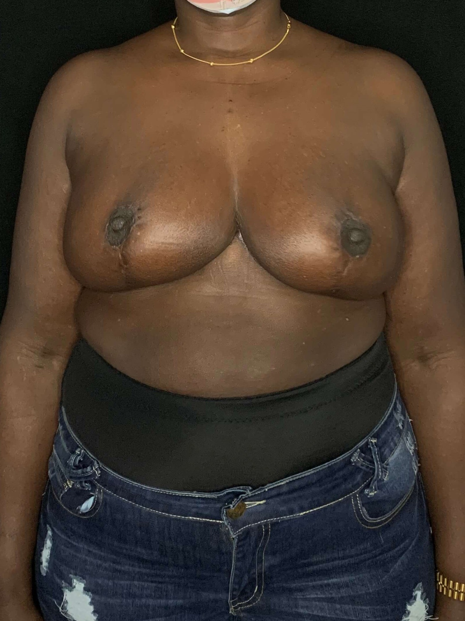 Breast Lift Reduction After
