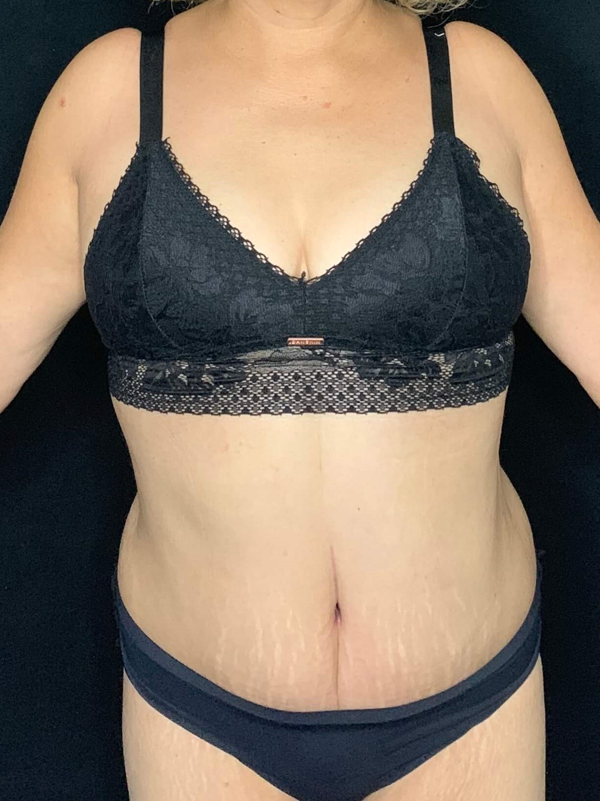 Abdominoplasty Tummy Tuck After