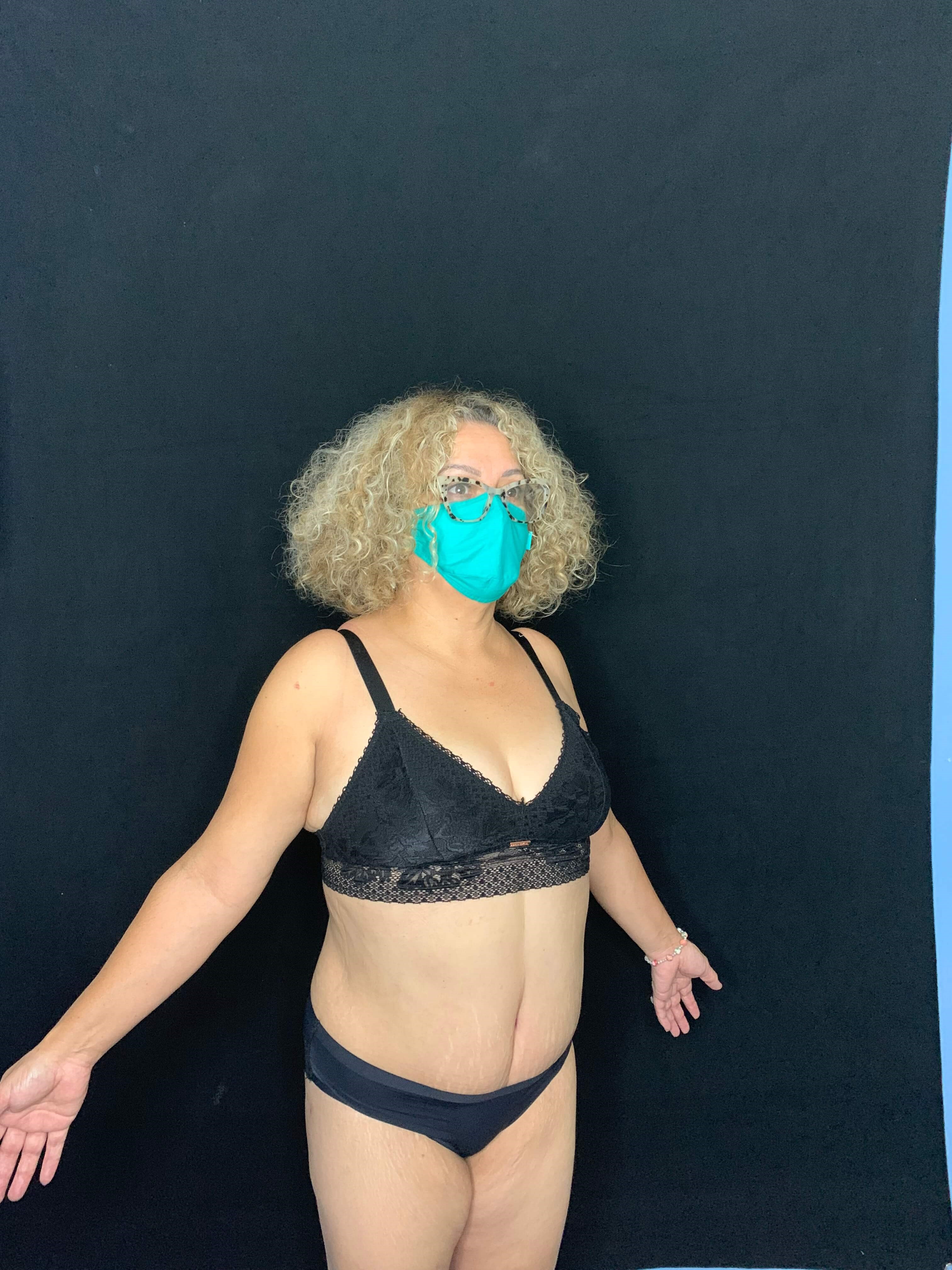 Tummy Tuck Liposuction After