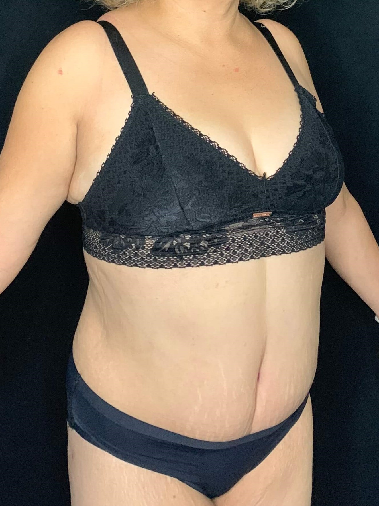 Tummy Tuck Liposuction After